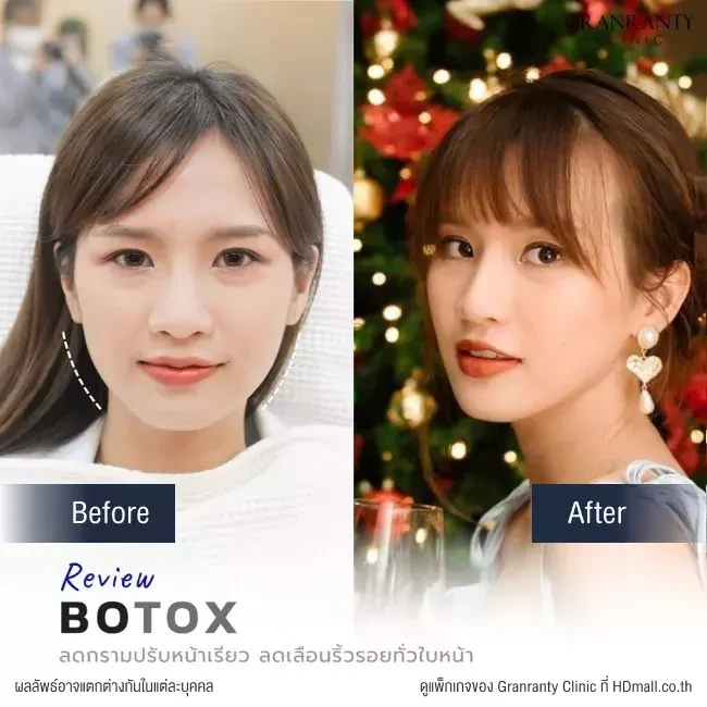 รีวิว ฉีดโบท็อกซ์ ลดกราม ปรับหน้าเรียว ที่ Granranty Clinic
