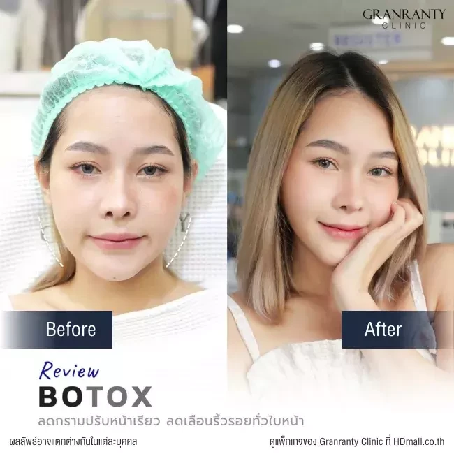 รีวิว ฉีดโบท็อกซ์ ลดกราม ปรับหน้าเรียว ที่ Granranty Clinic