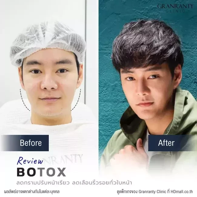 รีวิว ฉีดโบท็อกซ์ ลดกราม ปรับหน้าเรียว ที่ Granranty Clinic