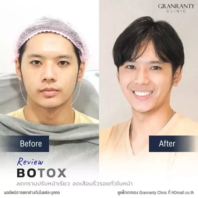 รีวิว ฉีดโบท็อกซ์ ลดกราม ปรับหน้าเรียว ที่ Granranty Clinic