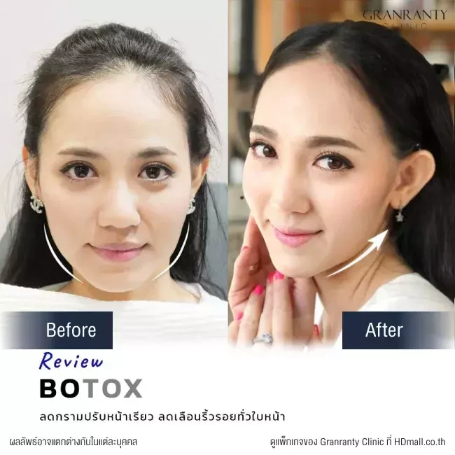 รีวิว ฉีดโบท็อกซ์ ลดกราม ปรับหน้าเรียว ที่ Granranty Clinic