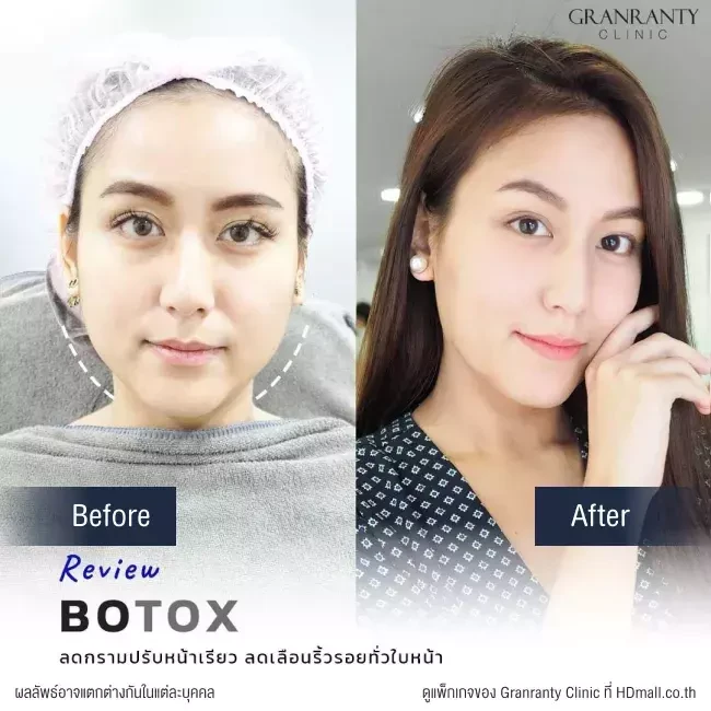 รีวิว ฉีดโบท็อกซ์ ลดกราม ปรับหน้าเรียว ที่ Granranty Clinic