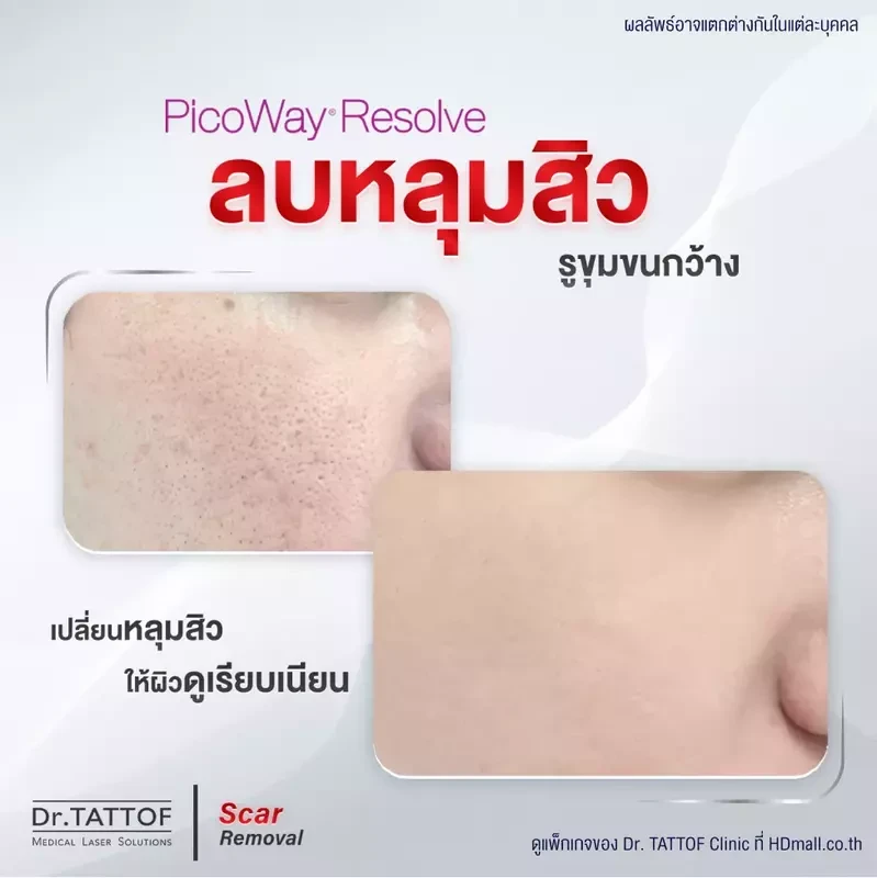 รีวิว รักษาหลุมสิว ด้วยเลเซอร์ PicoWay ที่ Dr. TATTOF Clinic