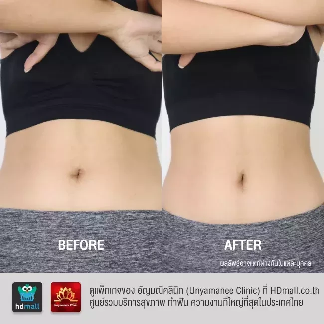 รีวิว สลายไขมัน ด้วยคาร์บ็อกซี Carboxy Therapy ที่ อัญมณีคลินิก Unyamanee clinic