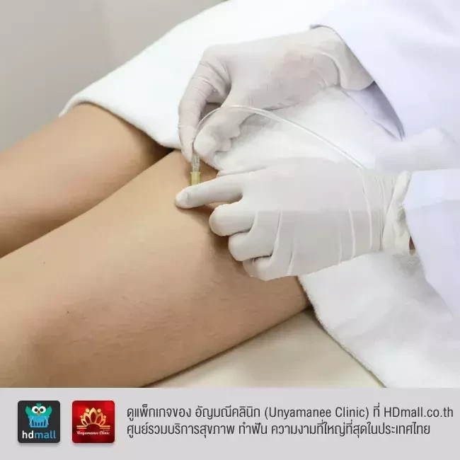 รีวิว สลายไขมัน ด้วยคาร์บ็อกซี Carboxy Therapy ที่ อัญมณีคลินิก Unyamanee clinic