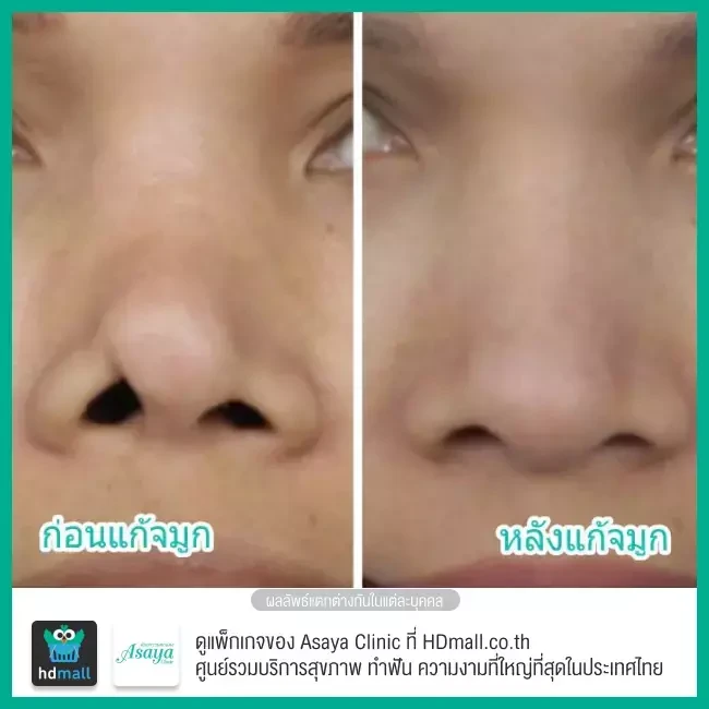 Before After แก้จมูก ที่ Asaya Clinic (อาศยาคลินิก)