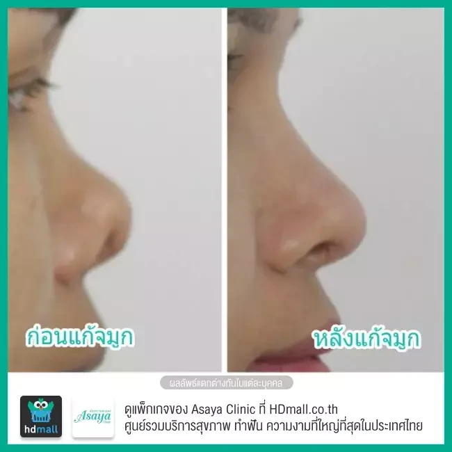 รีวิว แก้จมูก ที่ Asaya Clinic (อาศยาคลินิก)