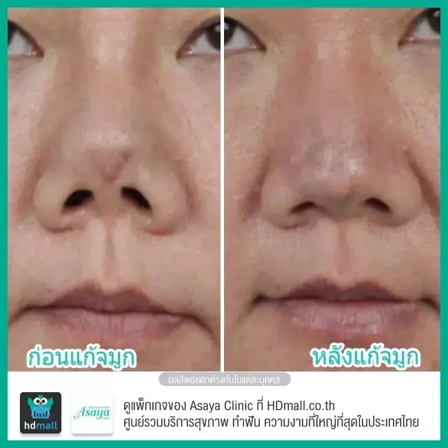 Before After แก้จมูก ที่ Asaya Clinic (อาศยาคลินิก)