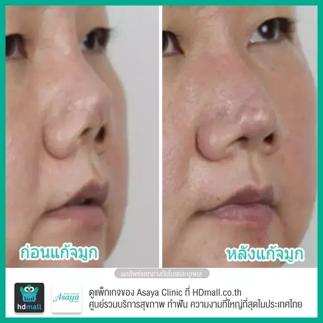 Before After แก้จมูก ที่ Asaya Clinic (อาศยาคลินิก)