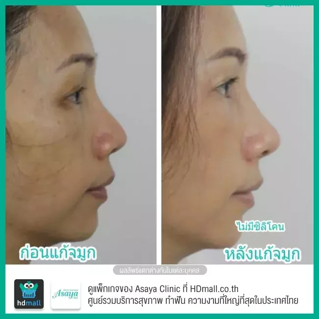 Before After แก้จมูก ที่ Asaya Clinic (อาศยาคลินิก)