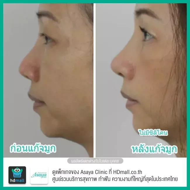 Before After แก้จมูก ที่ Asaya Clinic (อาศยาคลินิก)