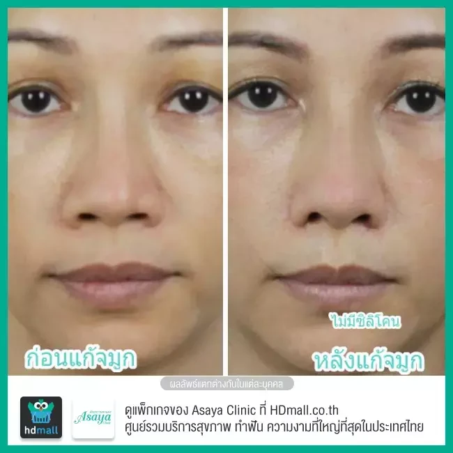 Before After แก้จมูก ที่ Asaya Clinic (อาศยาคลินิก)