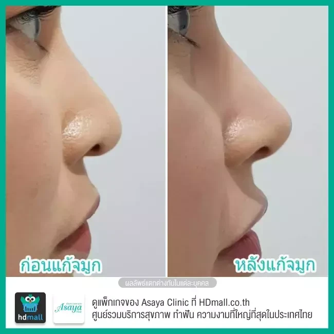 Before After แก้จมูก ที่ Asaya Clinic (อาศยาคลินิก)