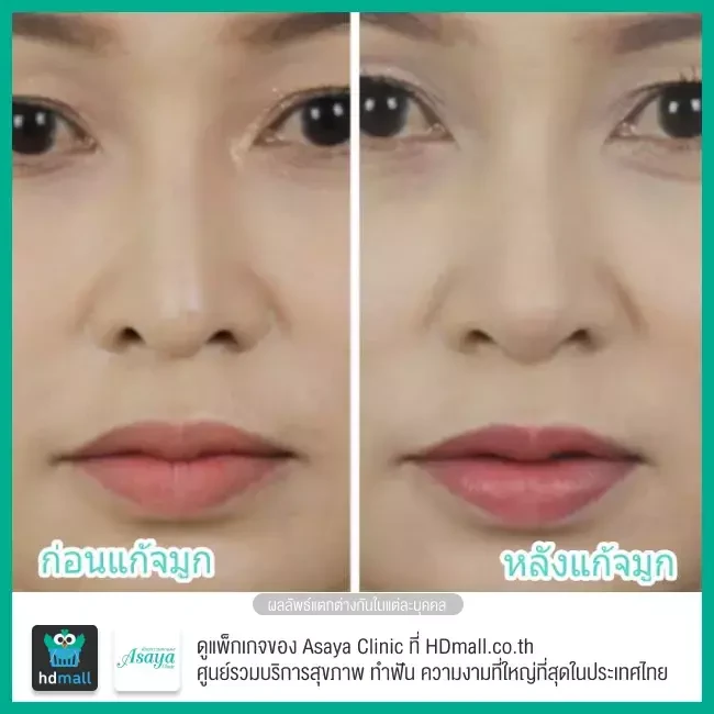 Before After แก้จมูก ที่ Asaya Clinic (อาศยาคลินิก)
