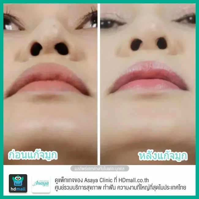 Before After แก้จมูก ที่ Asaya Clinic (อาศยาคลินิก)