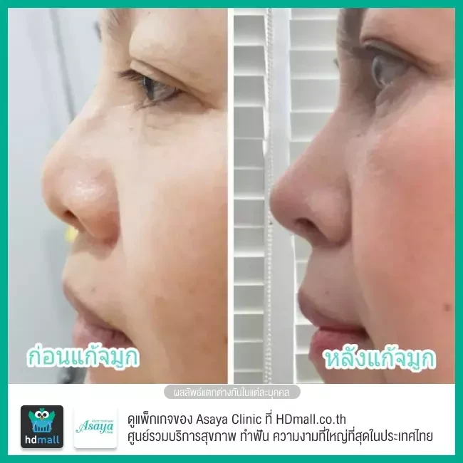 Before After แก้จมูก ที่ Asaya Clinic (อาศยาคลินิก)
