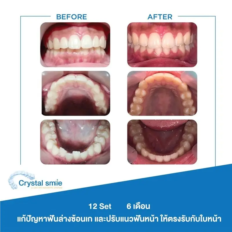 รวมรูปรีวิว จัดฟันใส Crystal Smile ที่ Bangkok Smile Dental