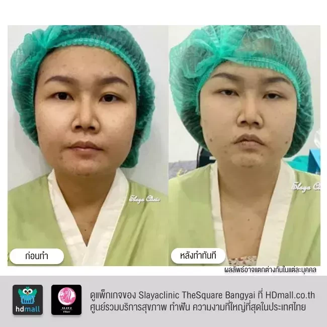รีวิว ตัดไขมันกระพุ้งแก้ม ที่ Slayaclinic TheSquare Bangyai