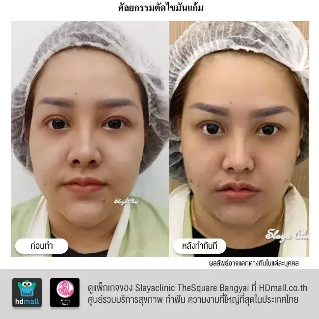 รีวิว ตัดไขมันกระพุ้งแก้ม ที่ Slayaclinic TheSquare Bangyai