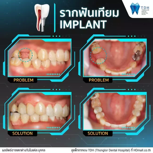 รีวิว ทำรากฟันเทียม ที่ Thonglor Dental Hospital (TDH)