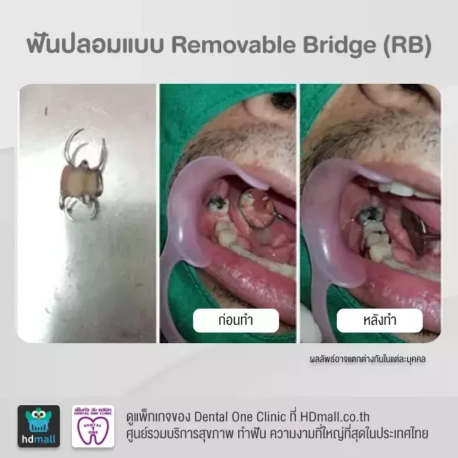รีวิว ทำฟันปลอม ที่ Dental One Clinic