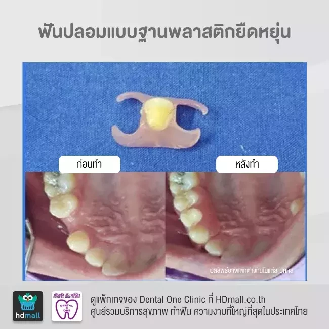 รีวิว ทำฟันปลอม ที่ Dental One Clinic