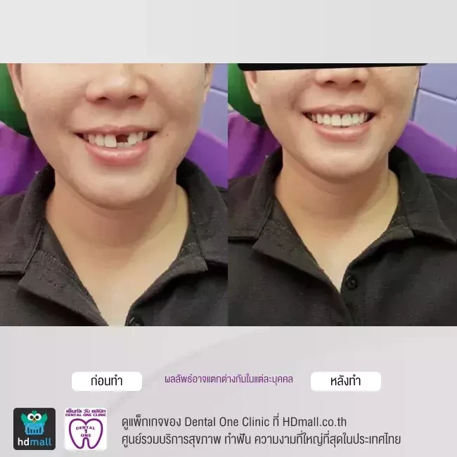 รีวิว ทำฟันปลอม ที่ Dental One Clinic