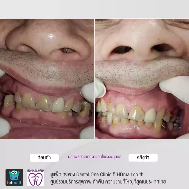 รีวิว ทำฟันปลอม ที่ Dental One Clinic