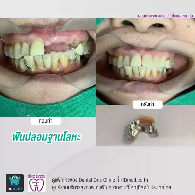 รีวิว ทำฟันปลอม ที่ Dental One Clinic