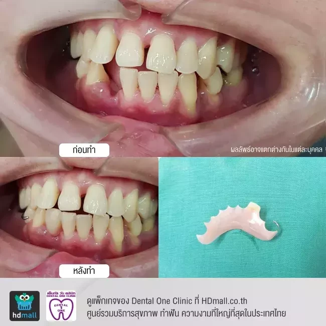 รีวิว ทำฟันปลอม ที่ Dental One Clinic