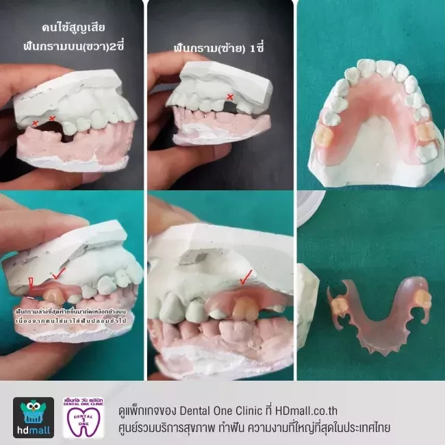 รีวิว ทำฟันปลอม ที่ Dental One Clinic