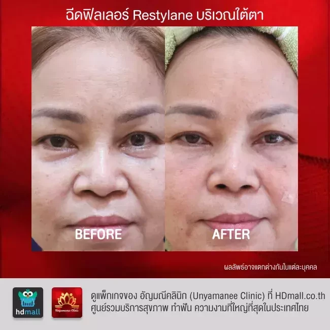 รีวิว ฉีดฟิลเลอร์ ที่ อัญมณีคลินิก Unyamanee clinic