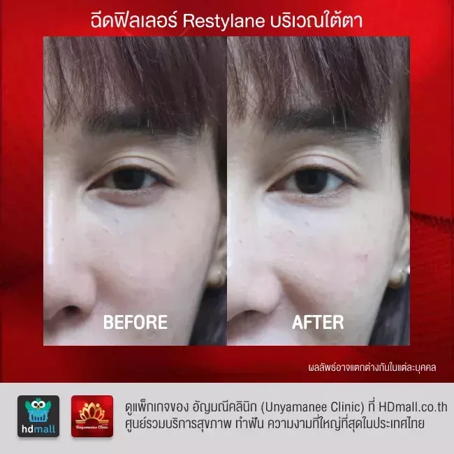 รีวิว ฉีดฟิลเลอร์ ที่ อัญมณีคลินิก Unyamanee clinic