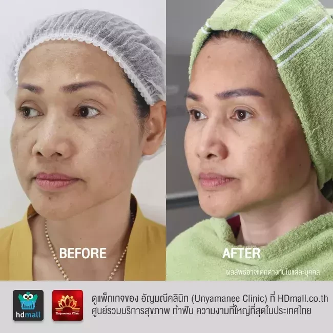 รีวิว รักษาฝ้า กระ รอยดำจากสิว ที่ อัญมณีคลินิก Unyamanee clinic