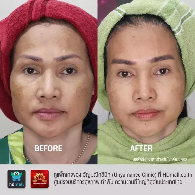รีวิว รักษาฝ้า กระ รอยดำจากสิว ที่ อัญมณีคลินิก Unyamanee clinic