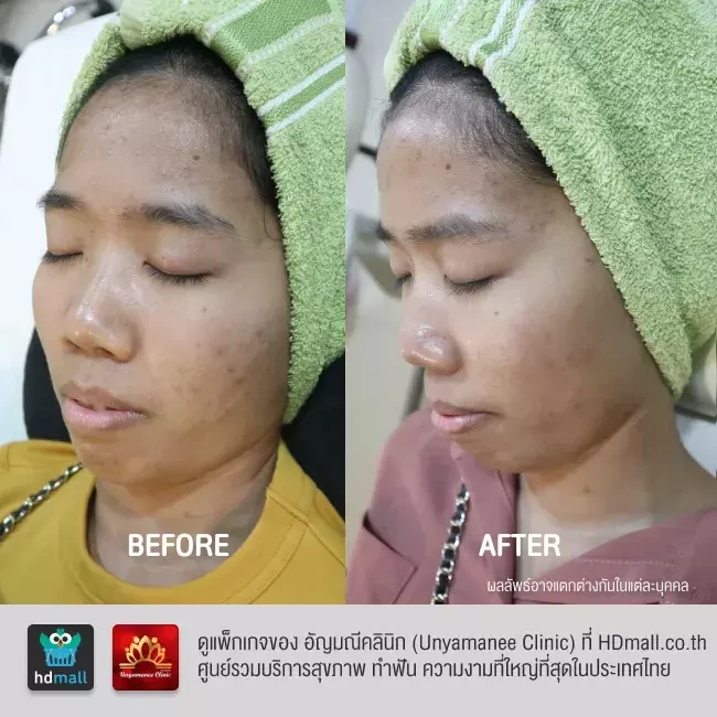 รีวิว รักษาฝ้า กระ รอยดำจากสิว ที่ อัญมณีคลินิก Unyamanee clinic