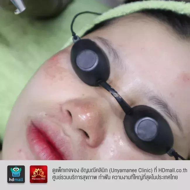 รีวิว รักษาฝ้า กระ รอยดำจากสิว ที่ อัญมณีคลินิก Unyamanee clinic