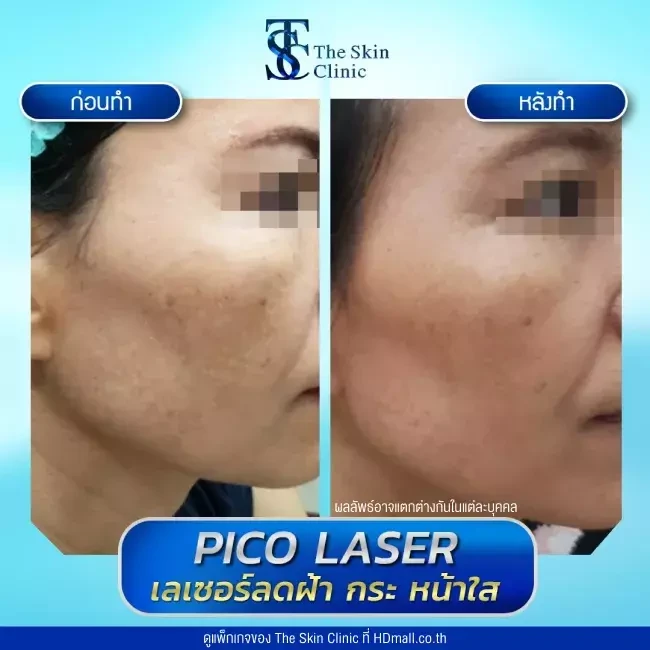 รีวิว Pico Laser ลดกระ ฝ้า จุดด่างดำ ที่ The Skin Clinic
