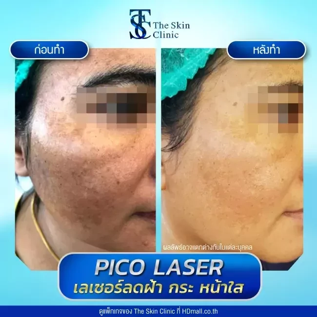 รีวิว Pico Laser ลดกระ ฝ้า จุดด่างดำ ที่ The Skin Clinic