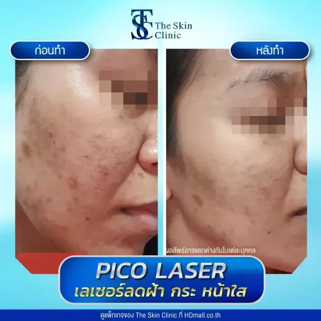 รีวิว Pico Laser ลดกระ ฝ้า จุดด่างดำ ที่ The Skin Clinic