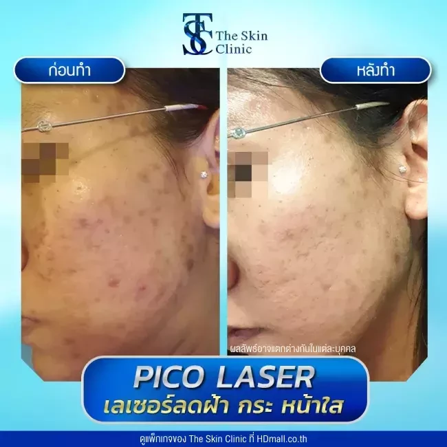 รีวิว Pico Laser ลดกระ ฝ้า จุดด่างดำ ที่ The Skin Clinic
