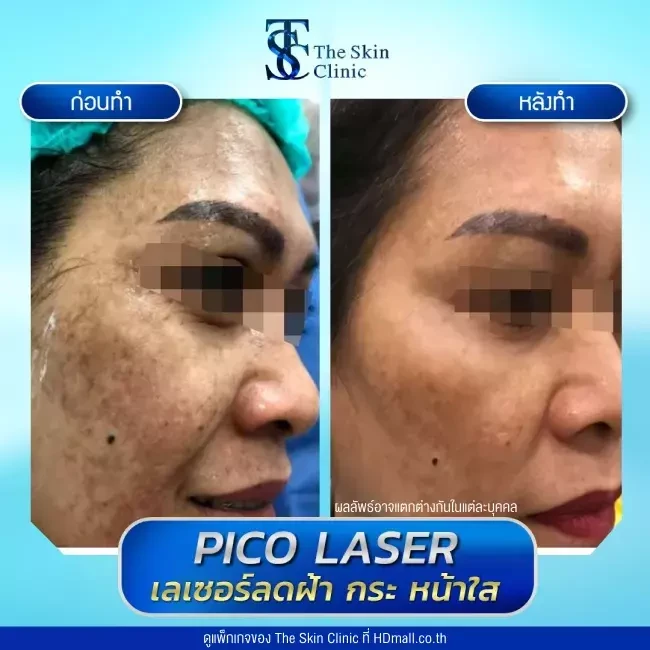 รีวิว Pico Laser ลดกระ ฝ้า จุดด่างดำ ที่ The Skin Clinic