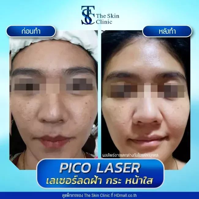 รีวิว Pico Laser ลดกระ ฝ้า จุดด่างดำ ที่ The Skin Clinic