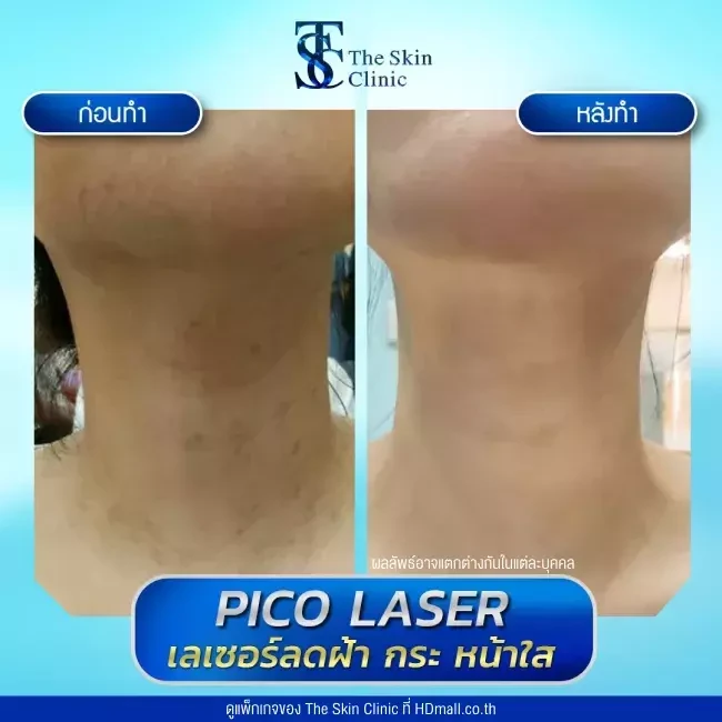 รีวิว Pico Laser ลดกระ ฝ้า จุดด่างดำ ที่ The Skin Clinic