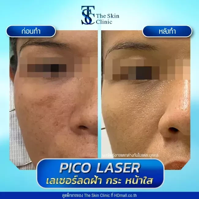 รีวิว Pico Laser ลดกระ ฝ้า จุดด่างดำ ที่ The Skin Clinic