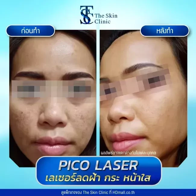 รีวิว Pico Laser ลดกระ ฝ้า จุดด่างดำ ที่ The Skin Clinic
