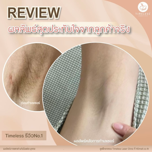 ผลลัพธ์หลังใช้บริการเลเซอร์กำจัดขน โปรแกรม Diode Laser ที่ Timeless Laser Clinic รูป 3