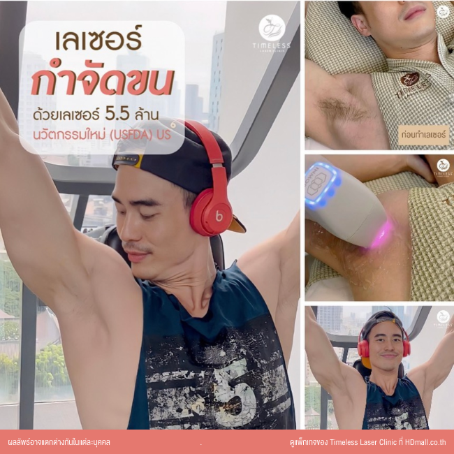 ผลลัพธ์หลังใช้บริการเลเซอร์กำจัดขน โปรแกรม Diode Laser ที่ Timeless Laser Clinic รูป 1