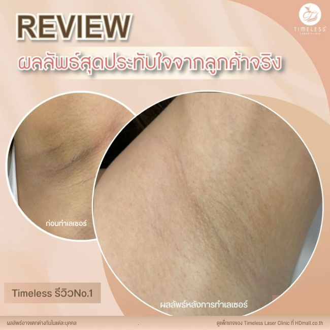 ผลลัพธ์หลังใช้บริการเลเซอร์กำจัดขน โปรแกรม Diode Laser ที่ Timeless Laser Clinic รูป 4