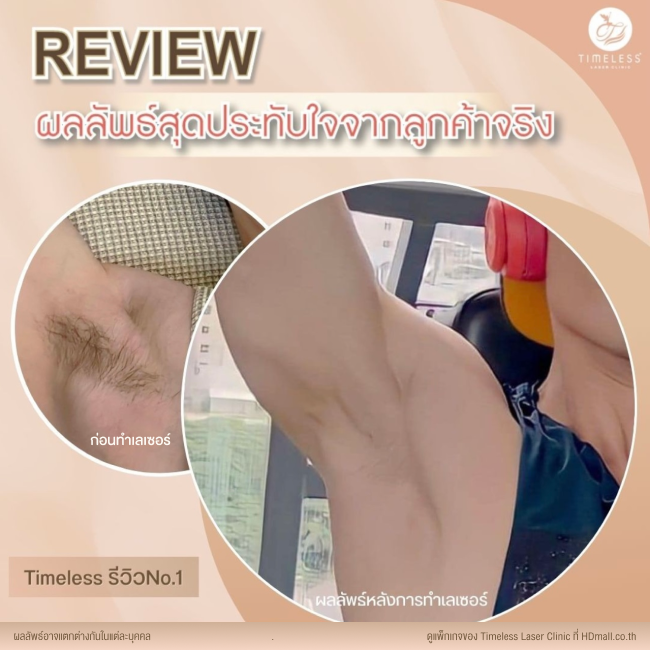 ผลลัพธ์หลังใช้บริการเลเซอร์กำจัดขน โปรแกรม Diode Laser ที่ Timeless Laser Clinic รูป 2